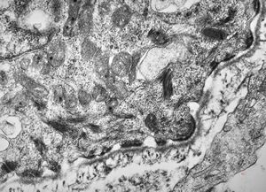 F,23y. | hemidesmosomes, basement membrane and anchoring fibrils … normal oral mucosa F,23y. | hemidesmosomes, basement membrane and anchoring fibrils … normal oral mucosa